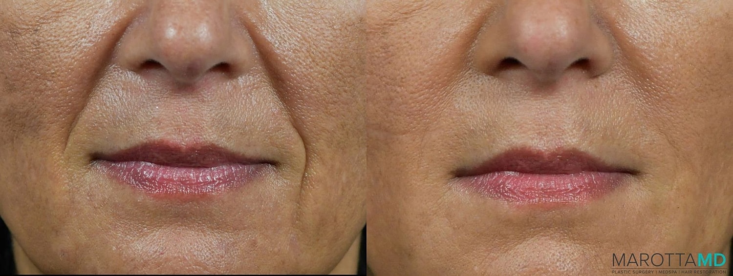 Dermal Fillers Before & After