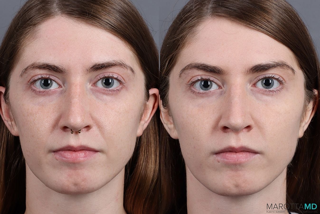 Dermal Fillers Before & After