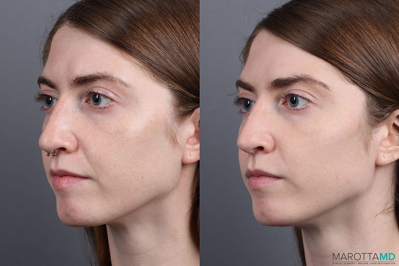 Dermal Fillers Before & After