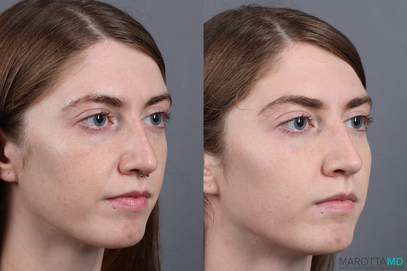 Dermal Fillers Before & After