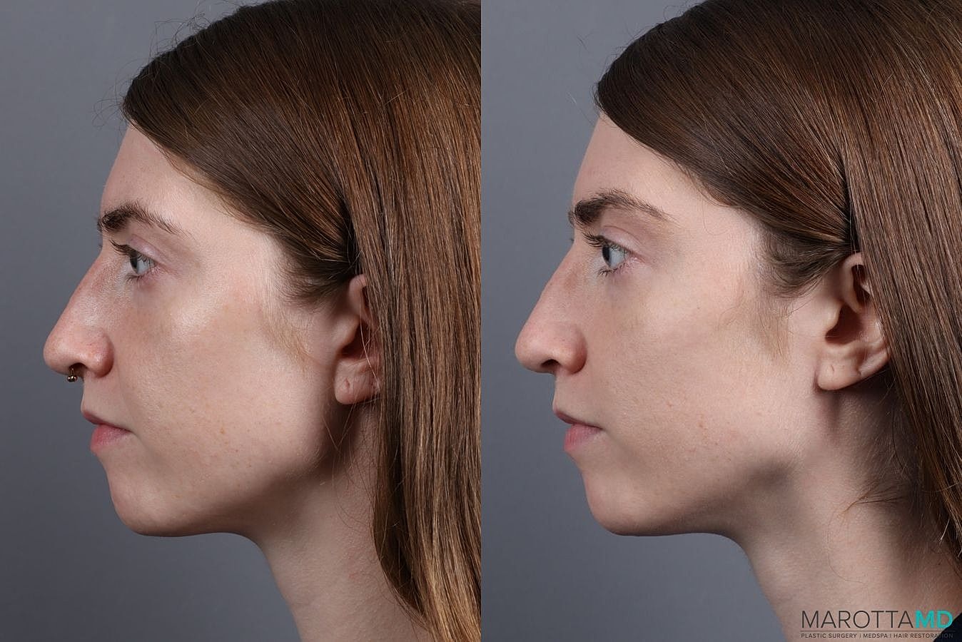 Dermal Fillers Before & After