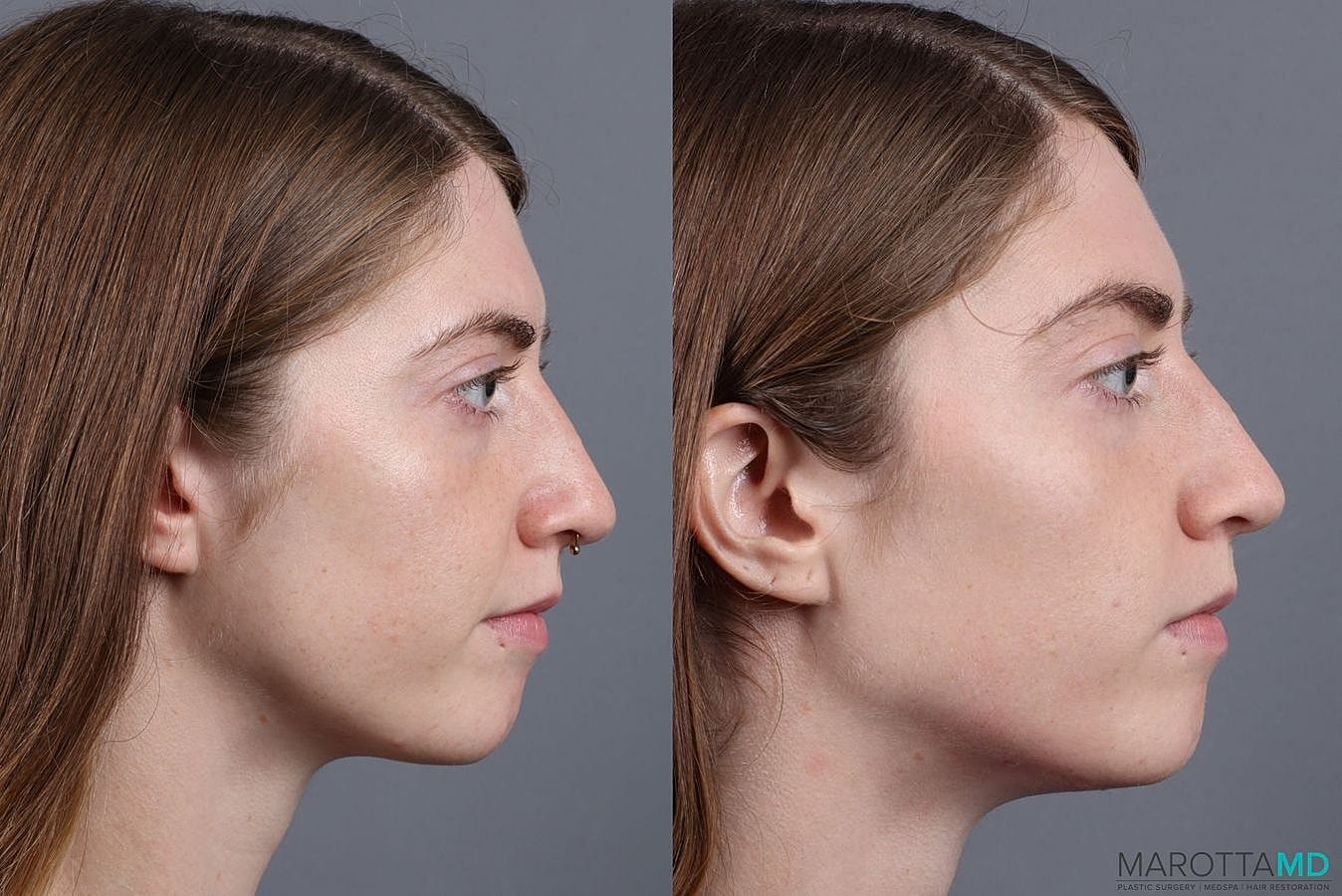 Dermal Fillers Before & After