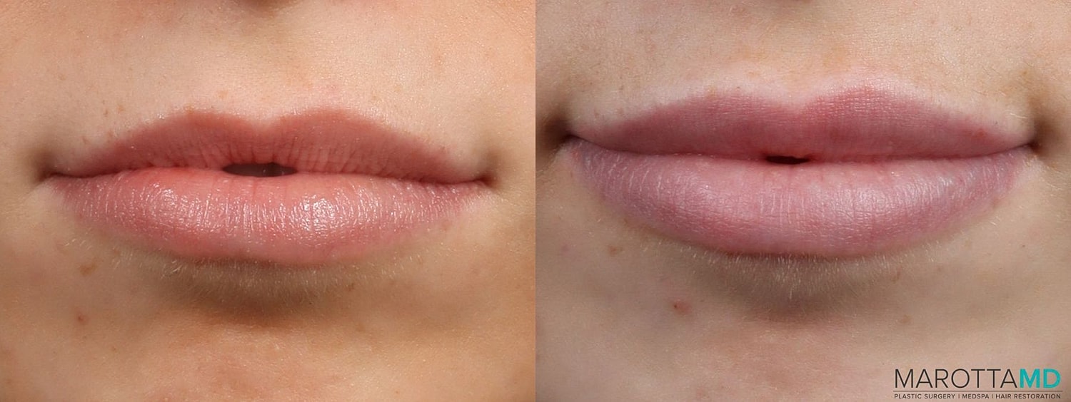 Dermal Fillers Before & After
