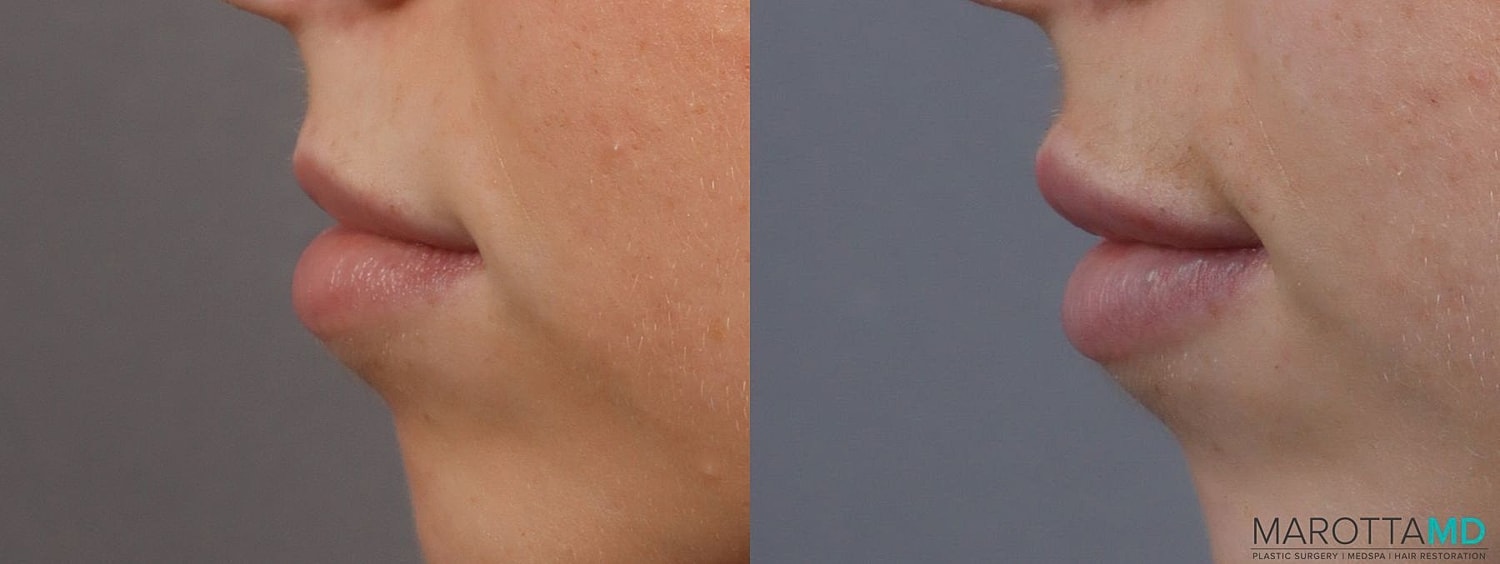 Dermal Fillers Before & After