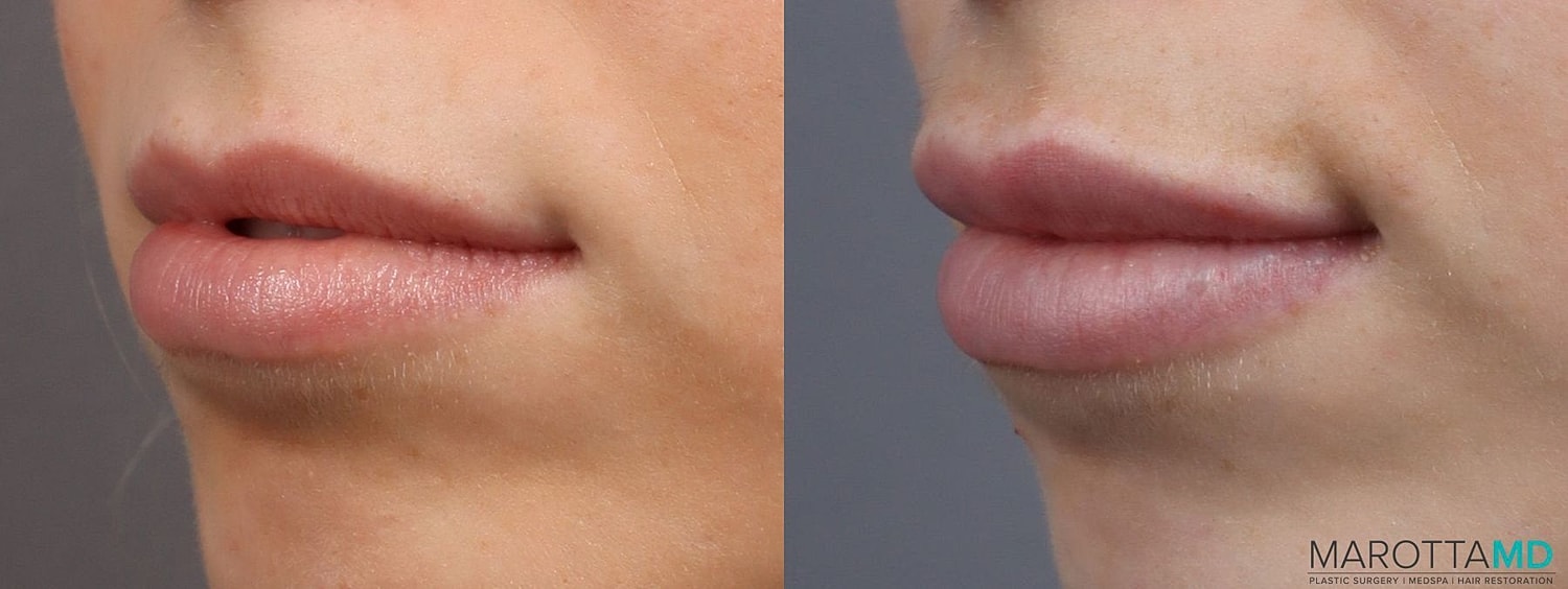 Dermal Fillers Before & After