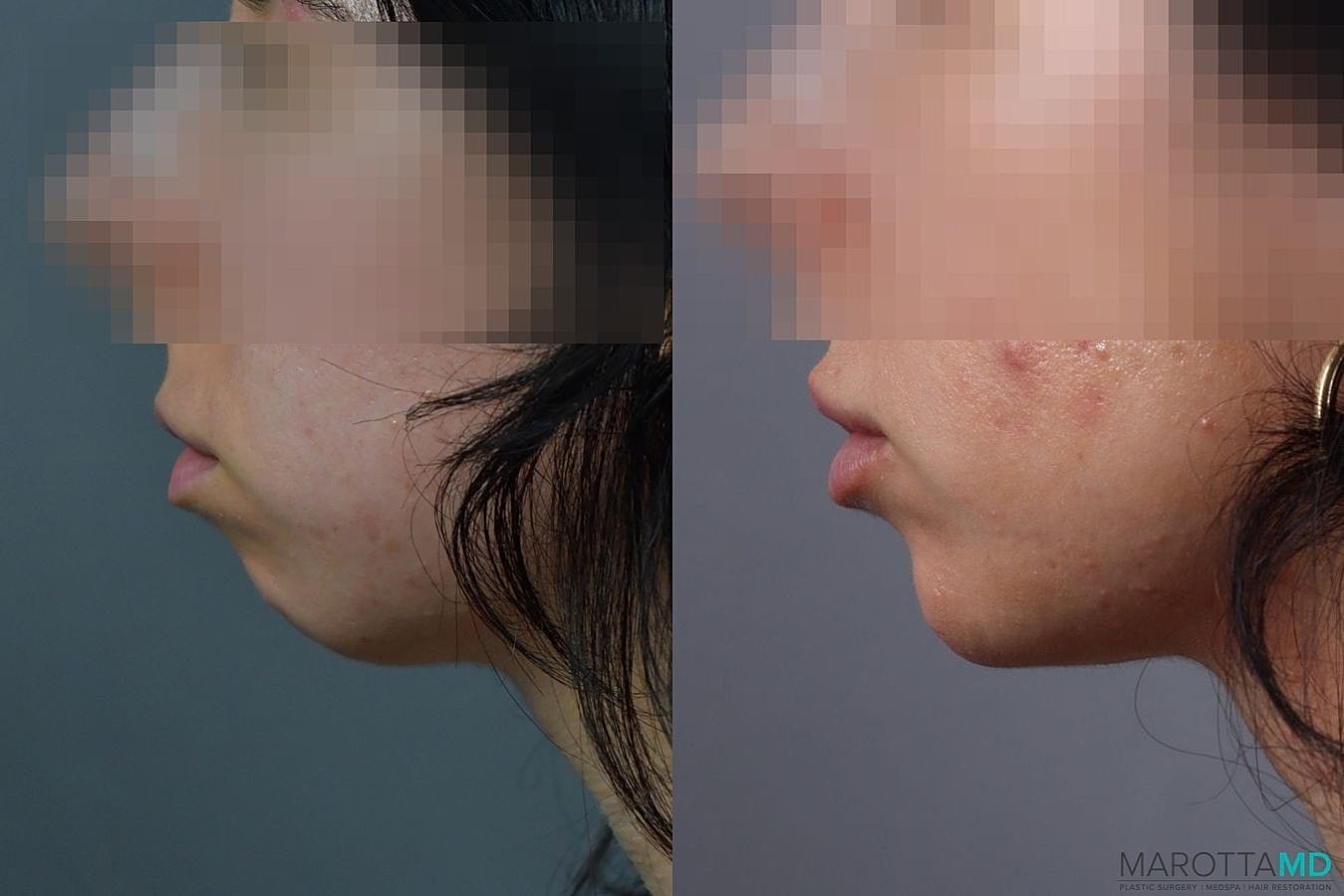 Dermal Fillers Before & After