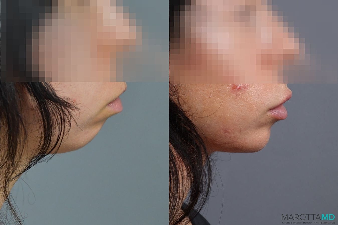 Dermal Fillers Before & After
