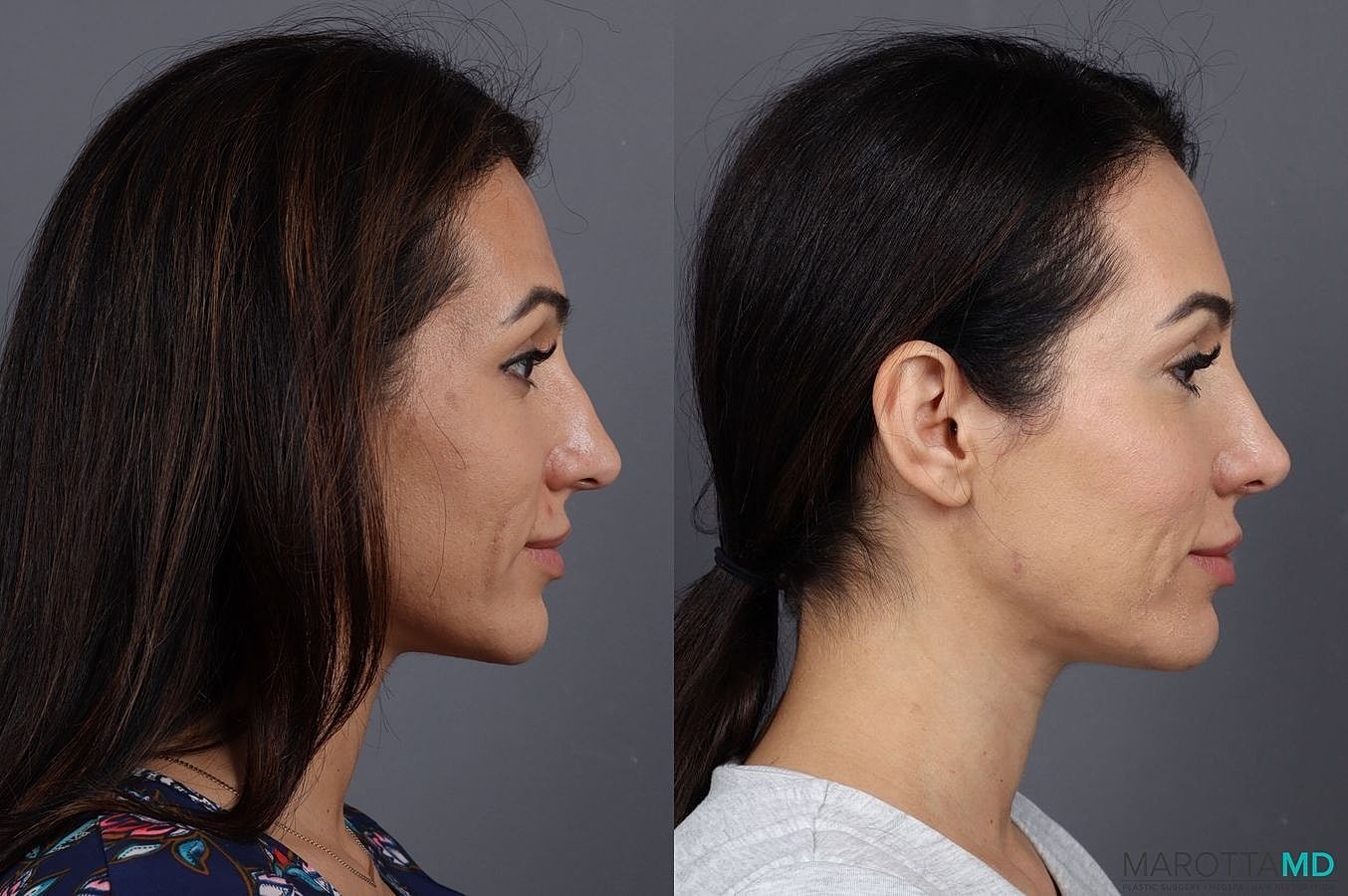 Dermal Fillers Before & After