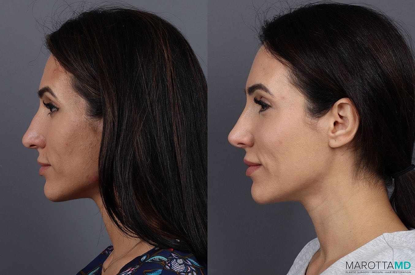 Dermal Fillers Before & After