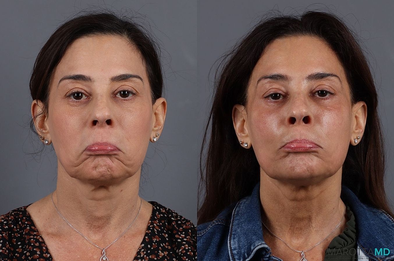 Dermal Fillers Before & After