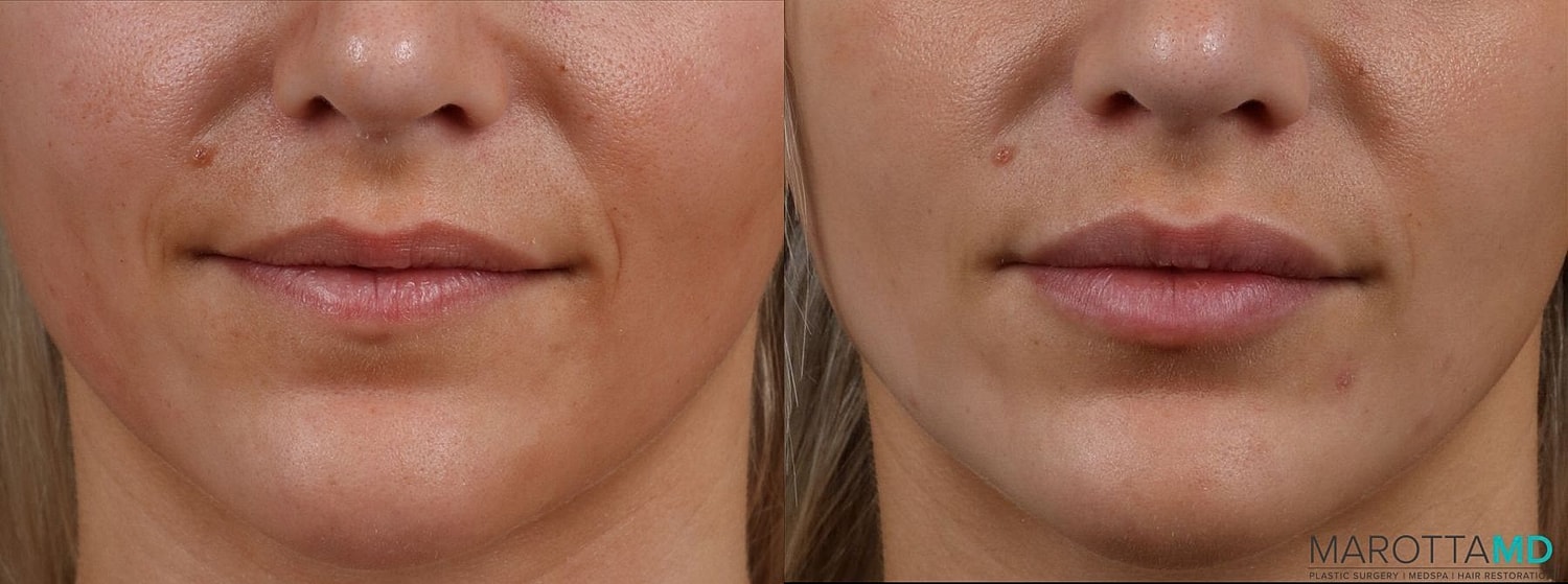 Dermal Fillers Before & After