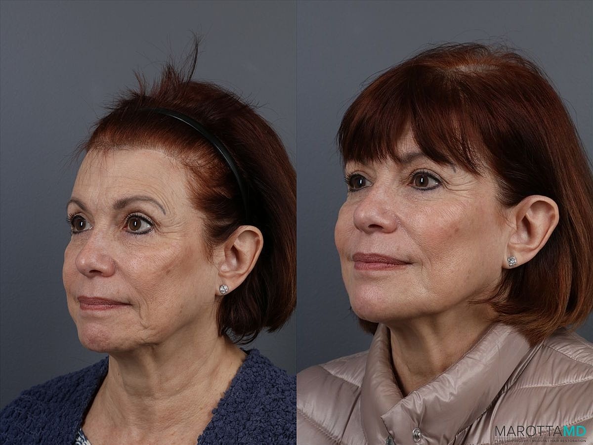 Dermal Fillers Before & After