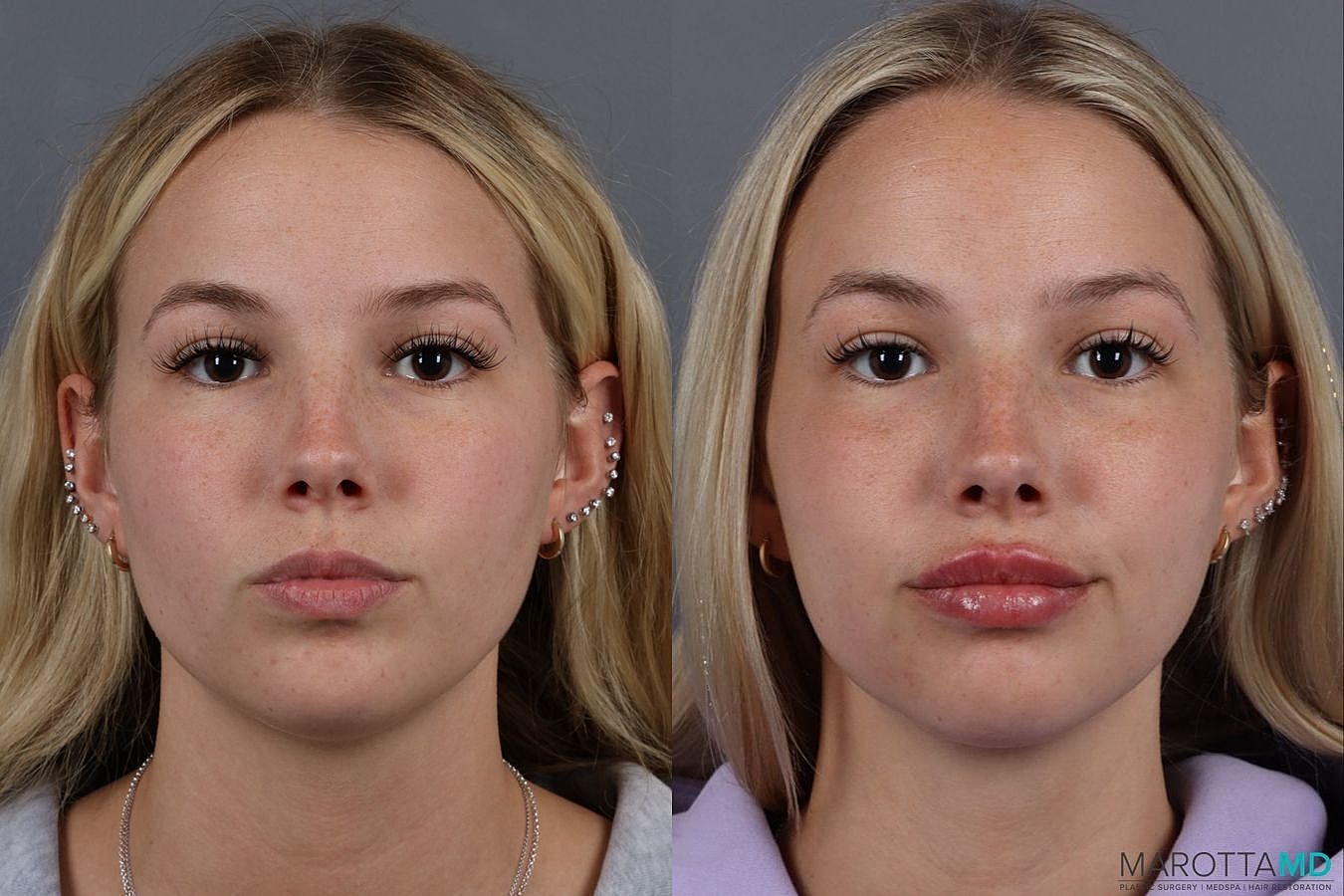 Dermal Fillers Before & After