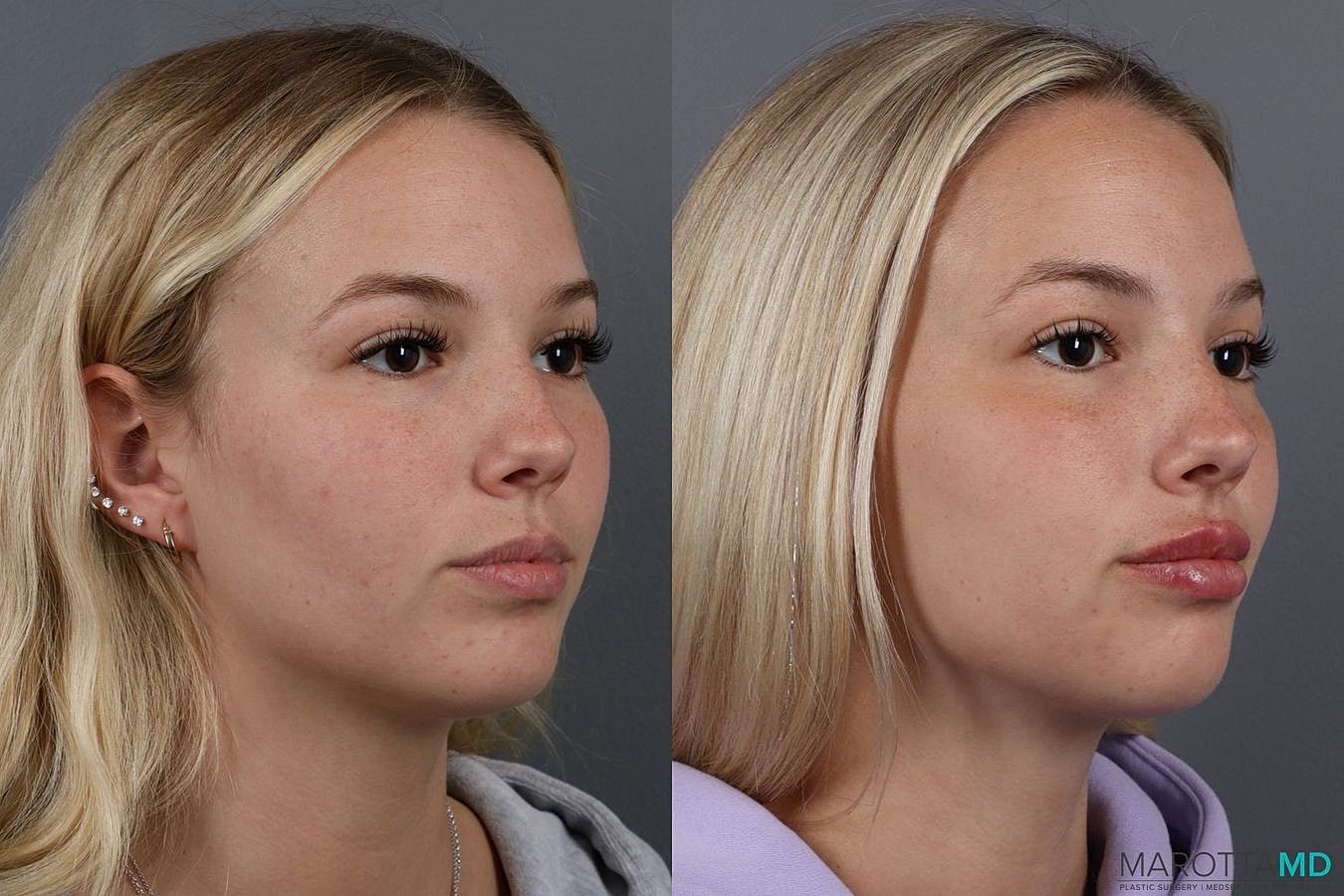 Dermal Fillers Before & After