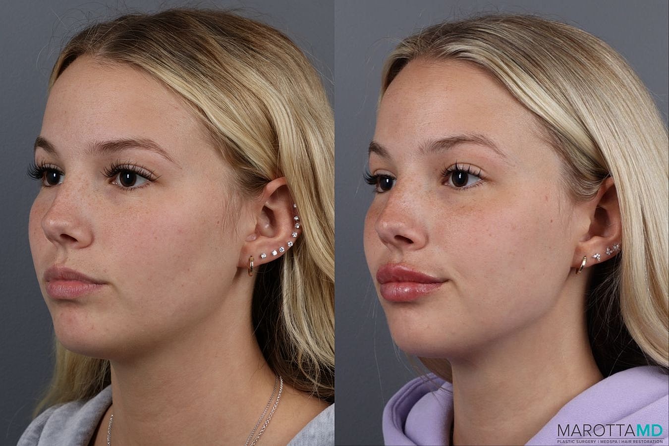 Dermal Fillers Before & After