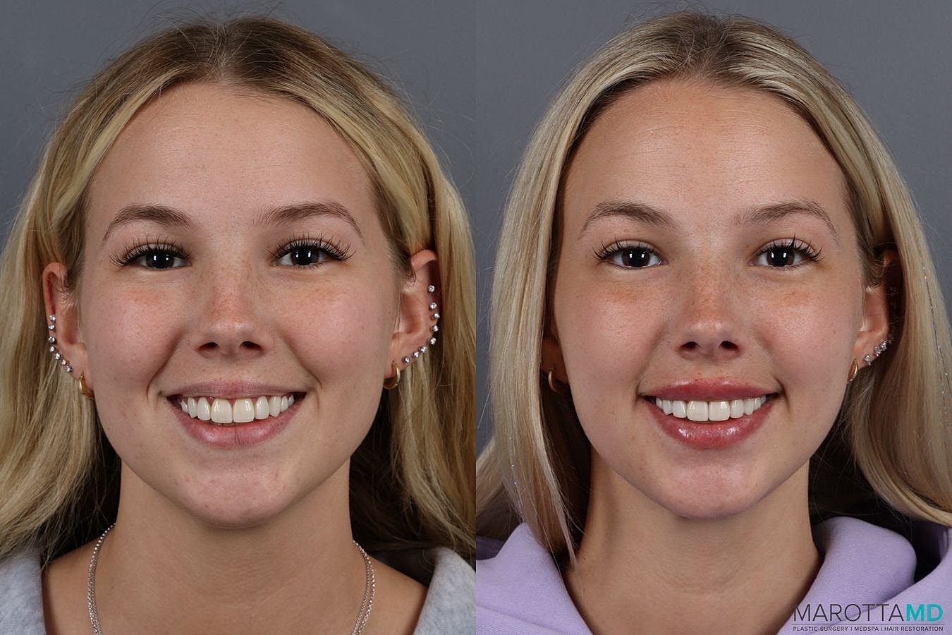 Dermal Fillers Before & After