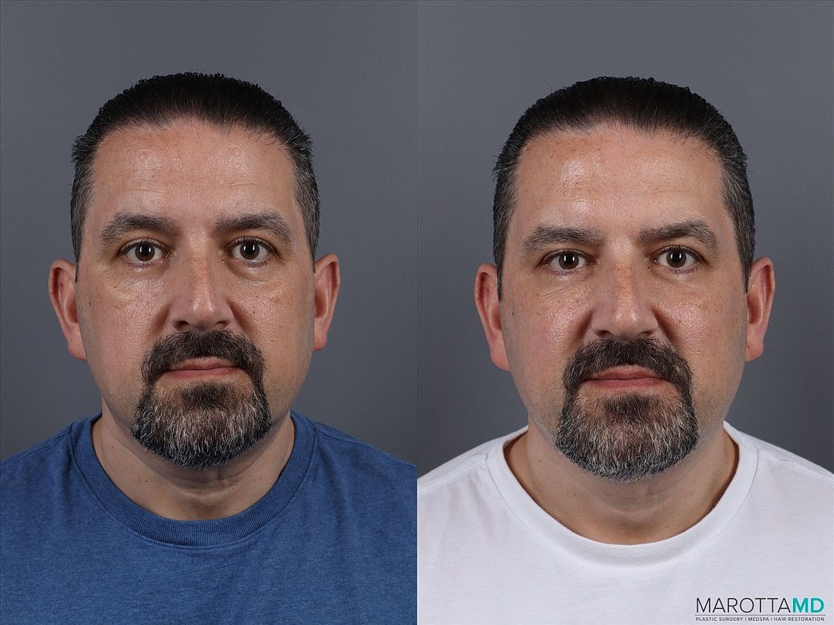 Dermal Fillers Before & After