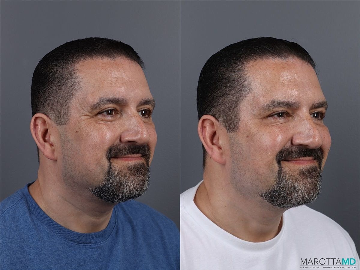 Dermal Fillers Before & After