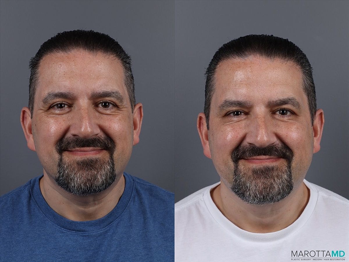 Dermal Fillers Before & After