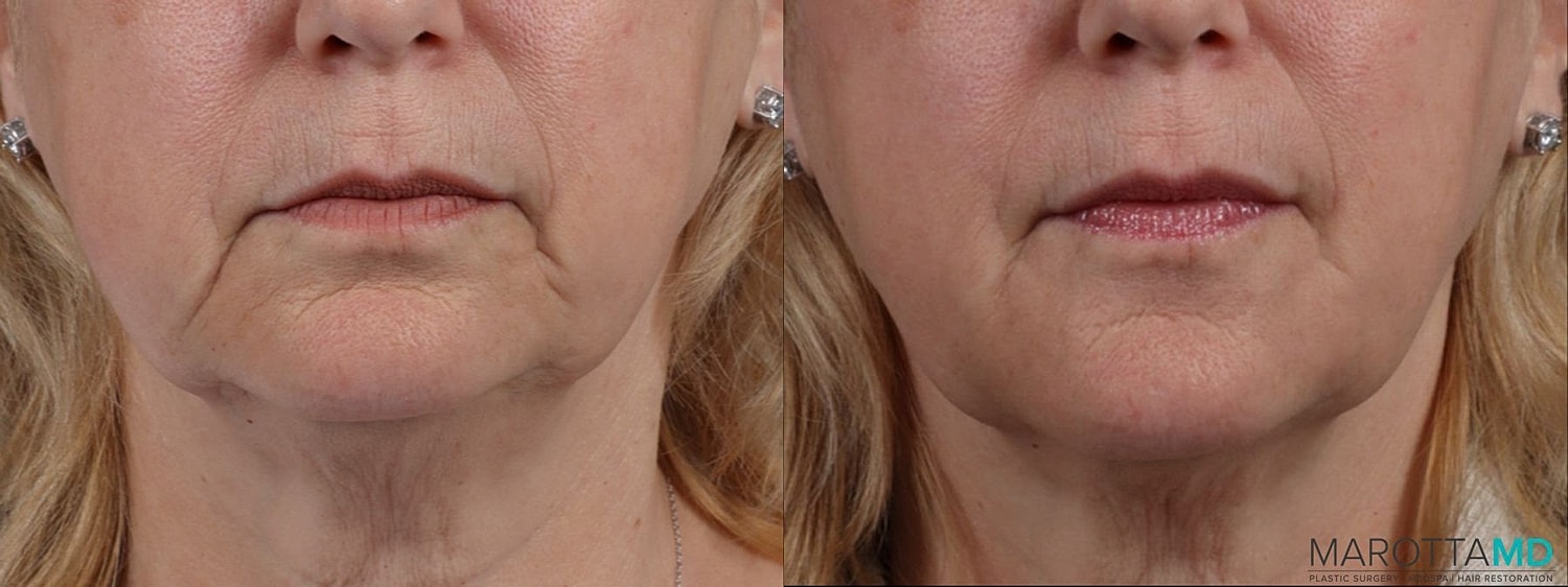 Dermal Fillers Before & After