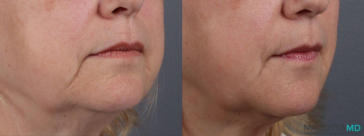 Dermal Fillers Before & After