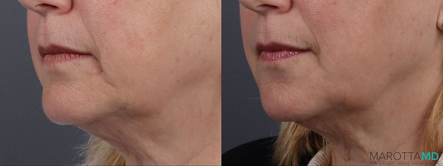 Dermal Fillers Before & After