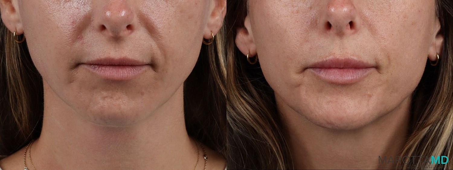 Dermal Fillers Before & After