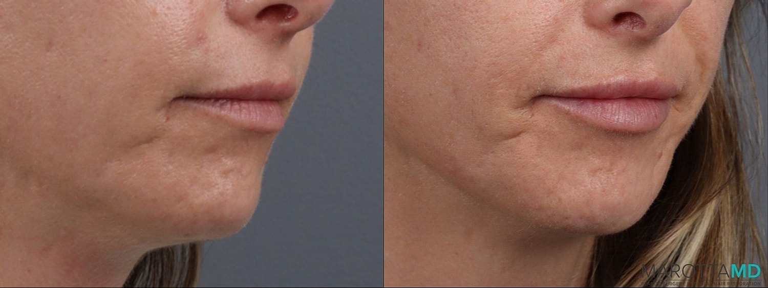 Dermal Fillers Before & After