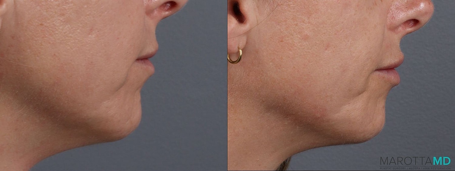 Dermal Fillers Before & After