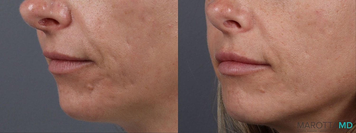 Dermal Fillers Before & After
