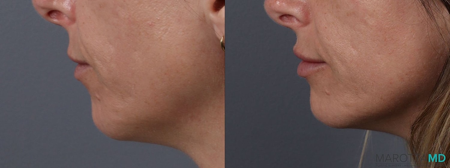 Dermal Fillers Before & After
