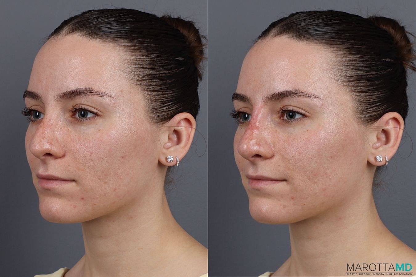 Dermal Fillers Before & After