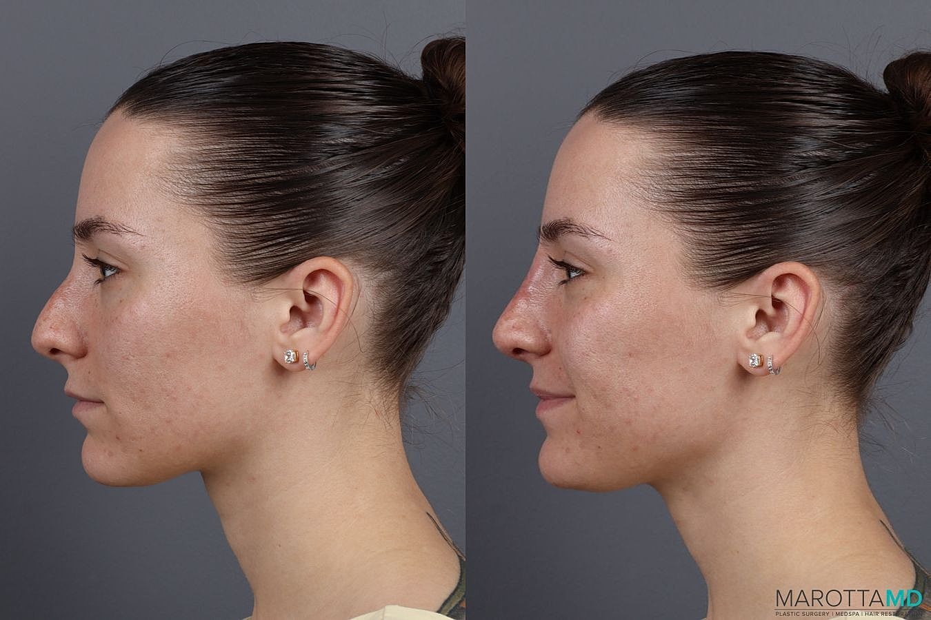 Dermal Fillers Before & After