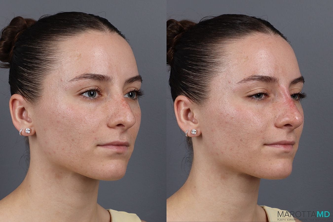 Dermal Fillers Before & After