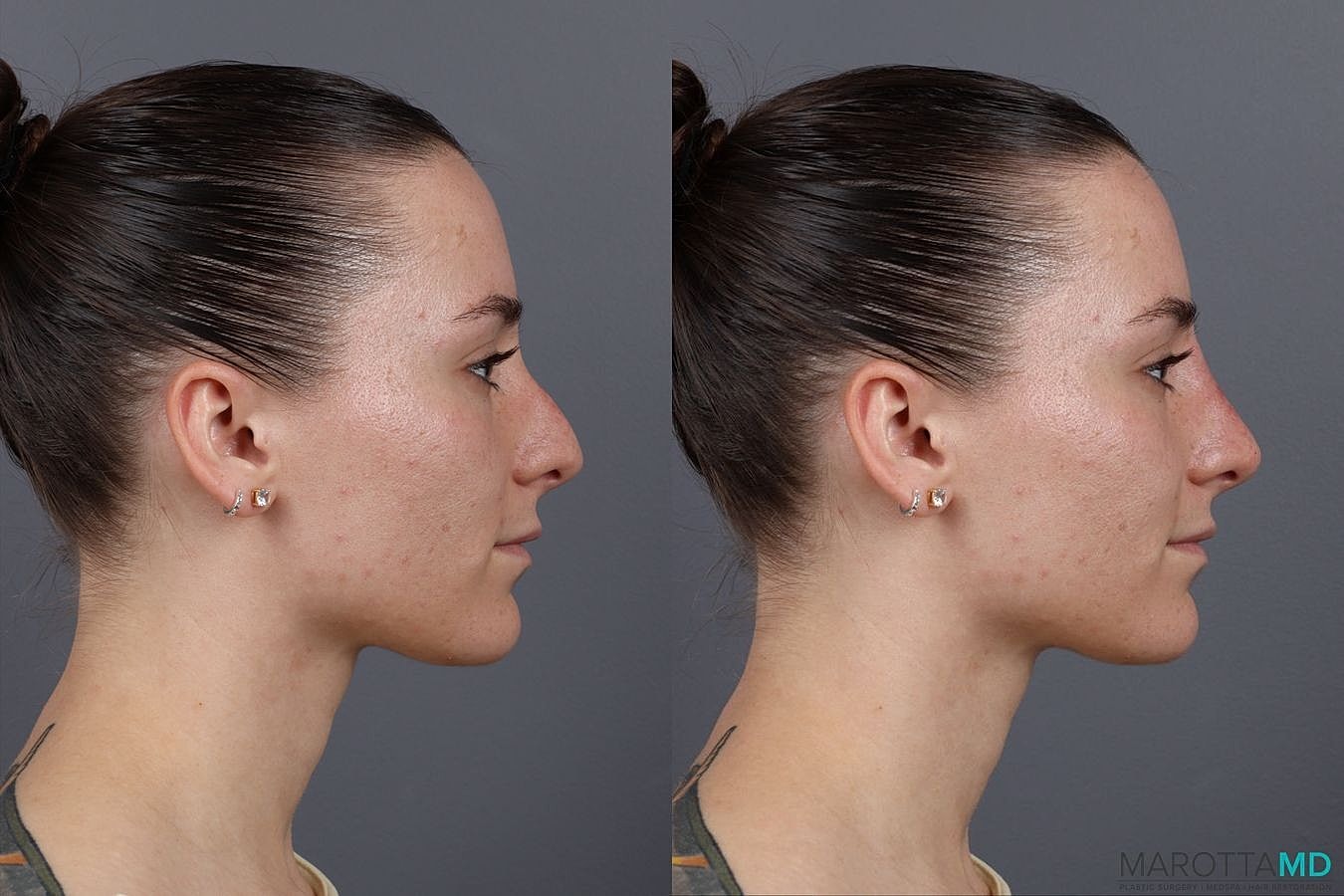 Dermal Fillers Before & After