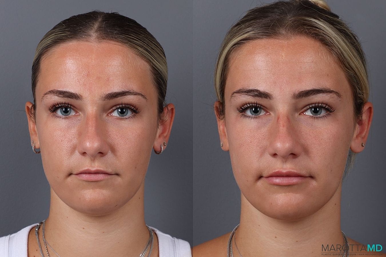 Dermal Fillers Before & After