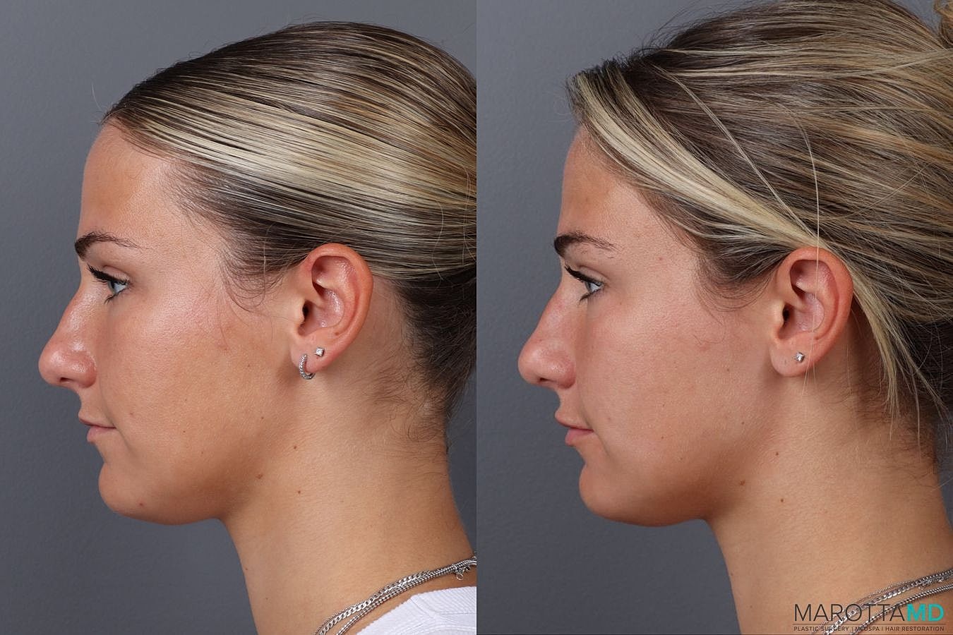 Dermal Fillers Before & After