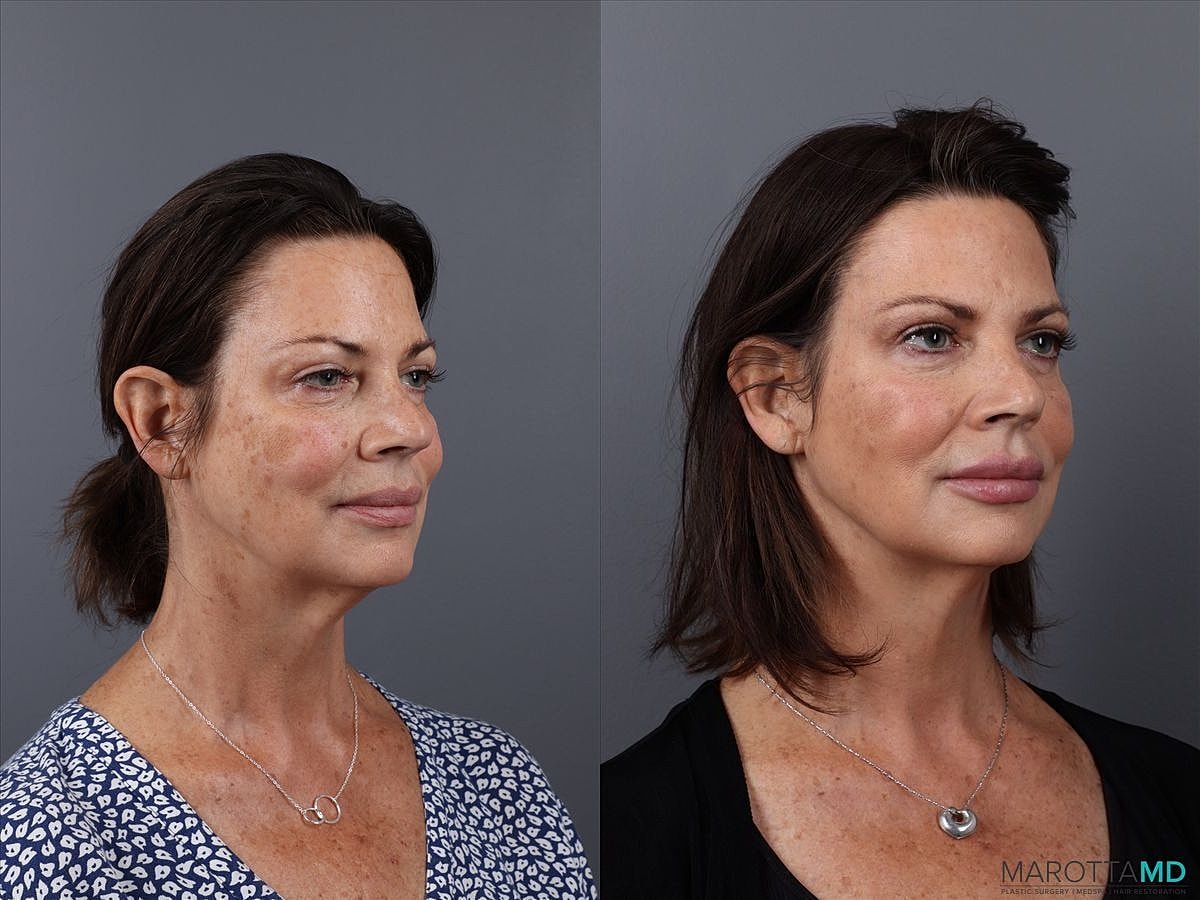 Dermal Fillers Before & After