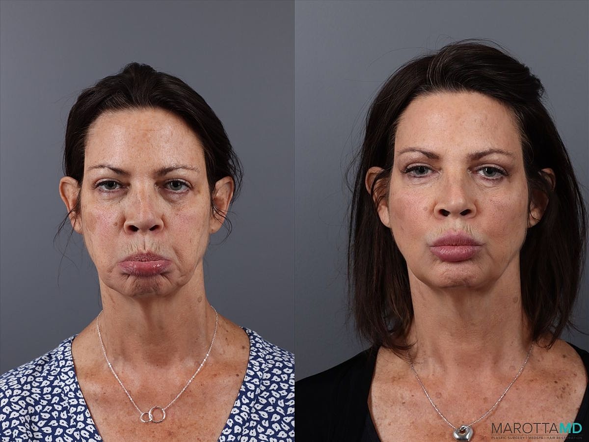 Dermal Fillers Before & After