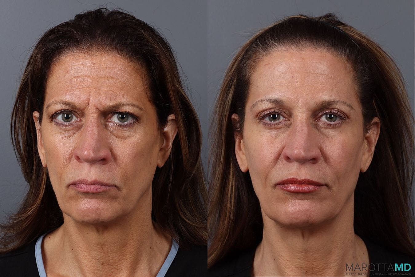 Dermal Fillers Before & After