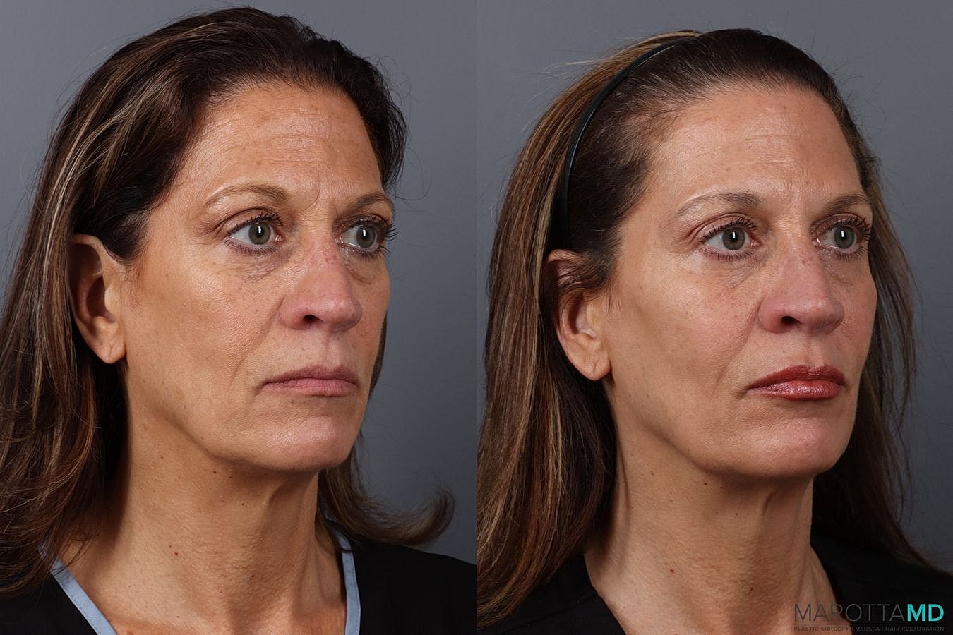 Dermal Fillers Before & After