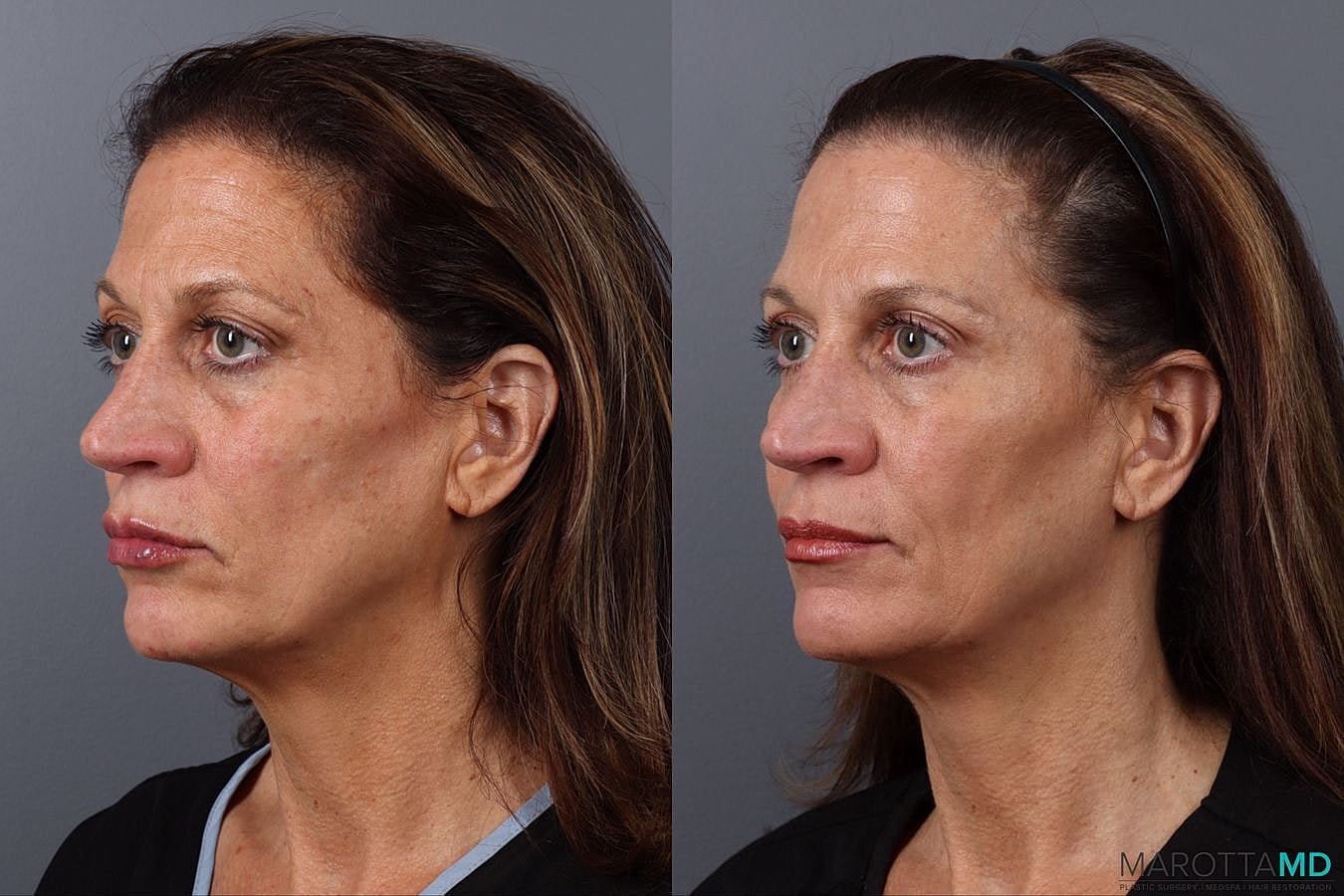 Dermal Fillers Before & After