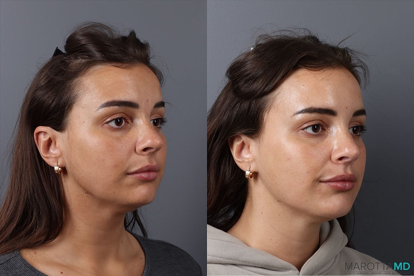 Dermal Fillers Before & After