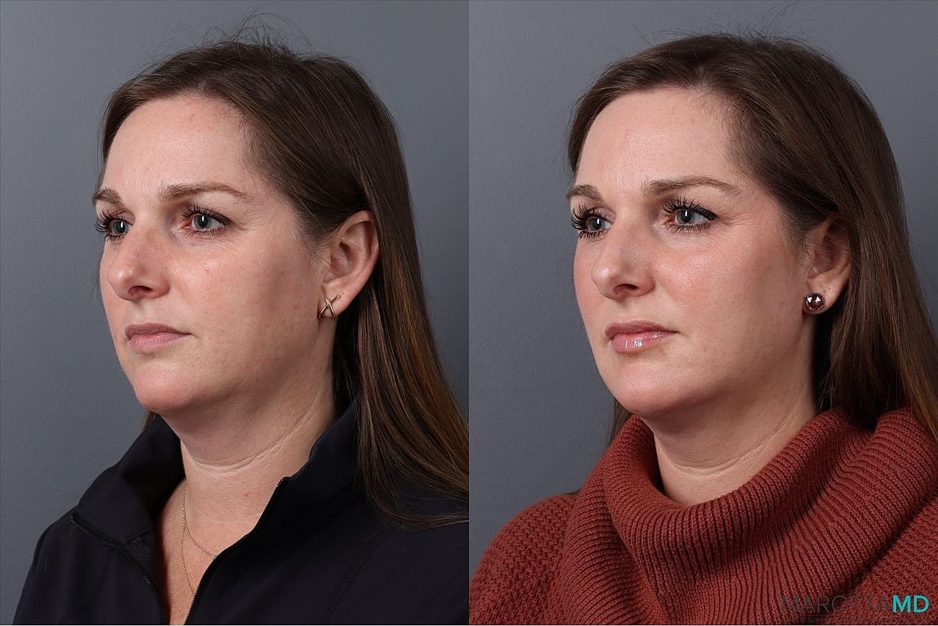 Dermal Fillers Before & After