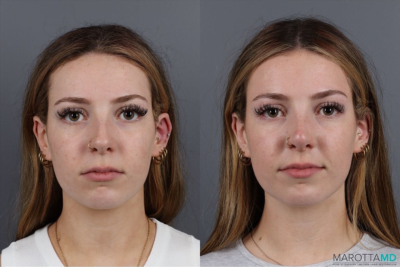Dermal Fillers Before & After