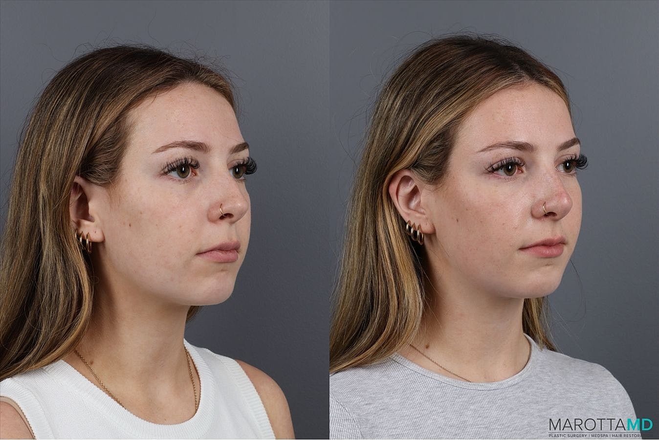 Dermal Fillers Before & After