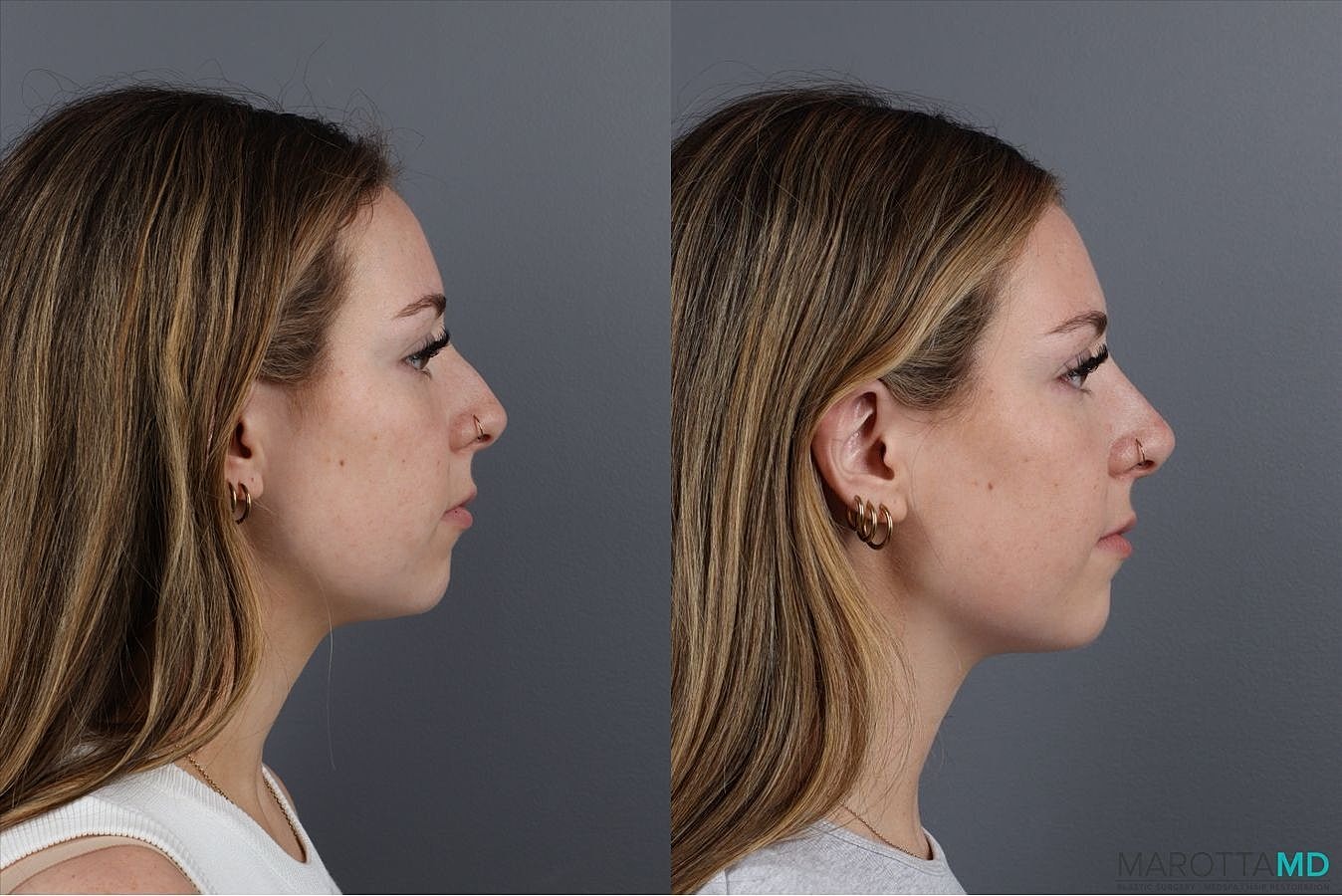 Dermal Fillers Before & After