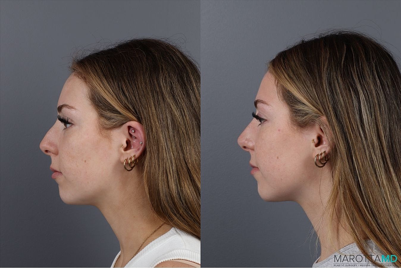 Dermal Fillers Before & After