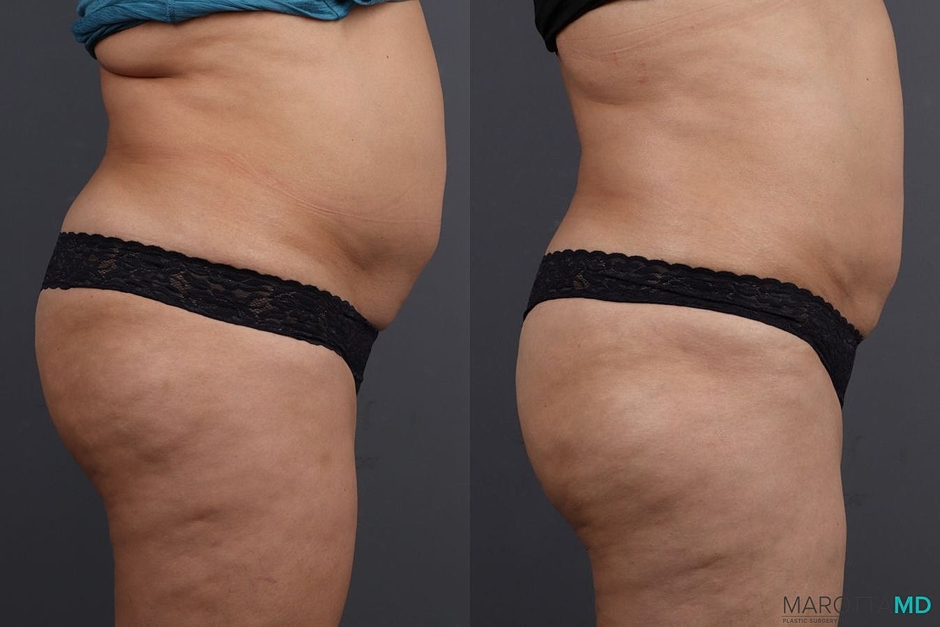 Emsculpt Neo Before & After