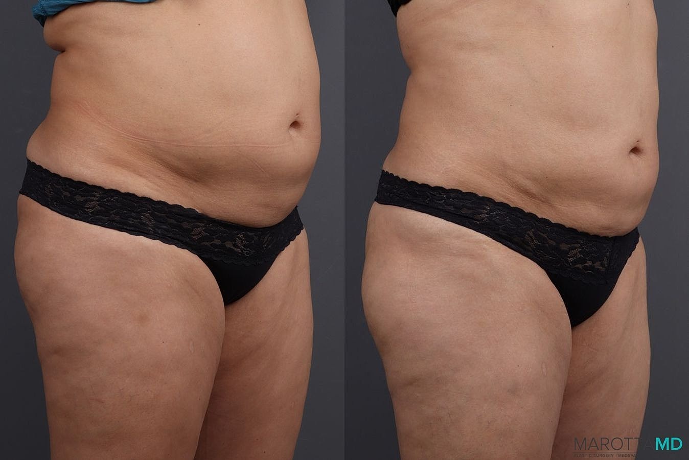 Emsculpt Neo Before & After